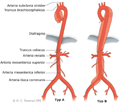 Akut aortadissektion