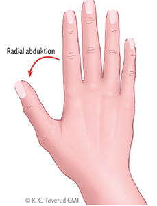 Figur 6. Radial abduktion